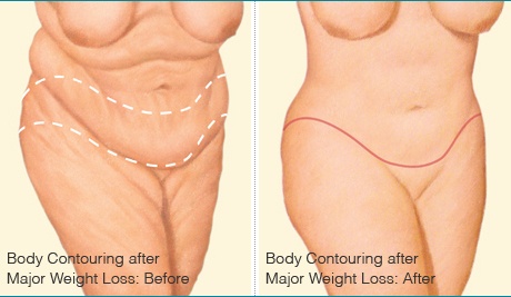 Tummy Tuck, Milwaukee & Madison