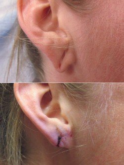 Gauge Torn Earlobe Repair San Diego CA