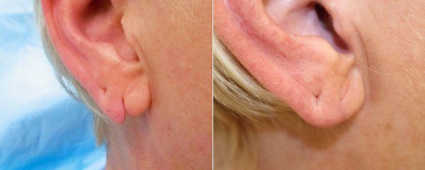 Earlobe repair before & after