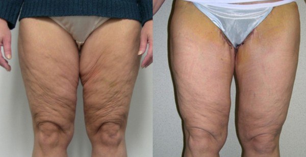 Thigh Lift before & after