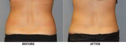 CoolSculpting before & after