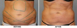 CoolSculpting before & after
