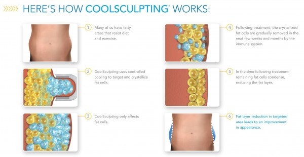 How CoolSculpting works