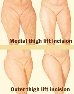 Thigh Lift Scars: Where Are Incisions For Different Thigh Lifts Made?