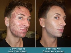 Profractional with Colorescience