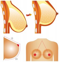 Breast lift graphic