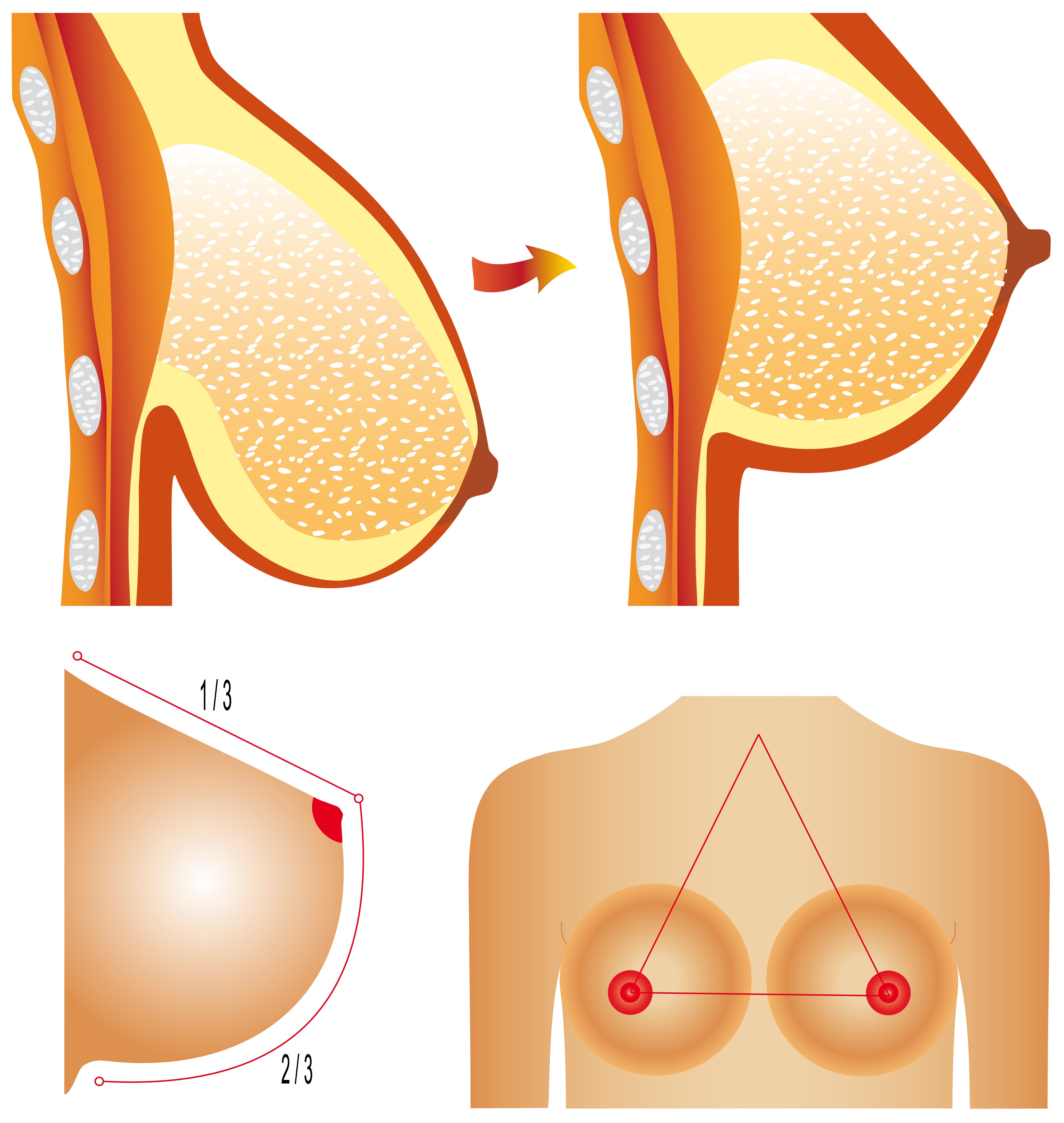 Fox Valley Plastic Surgery Breast Lift Mastopexy Surgery