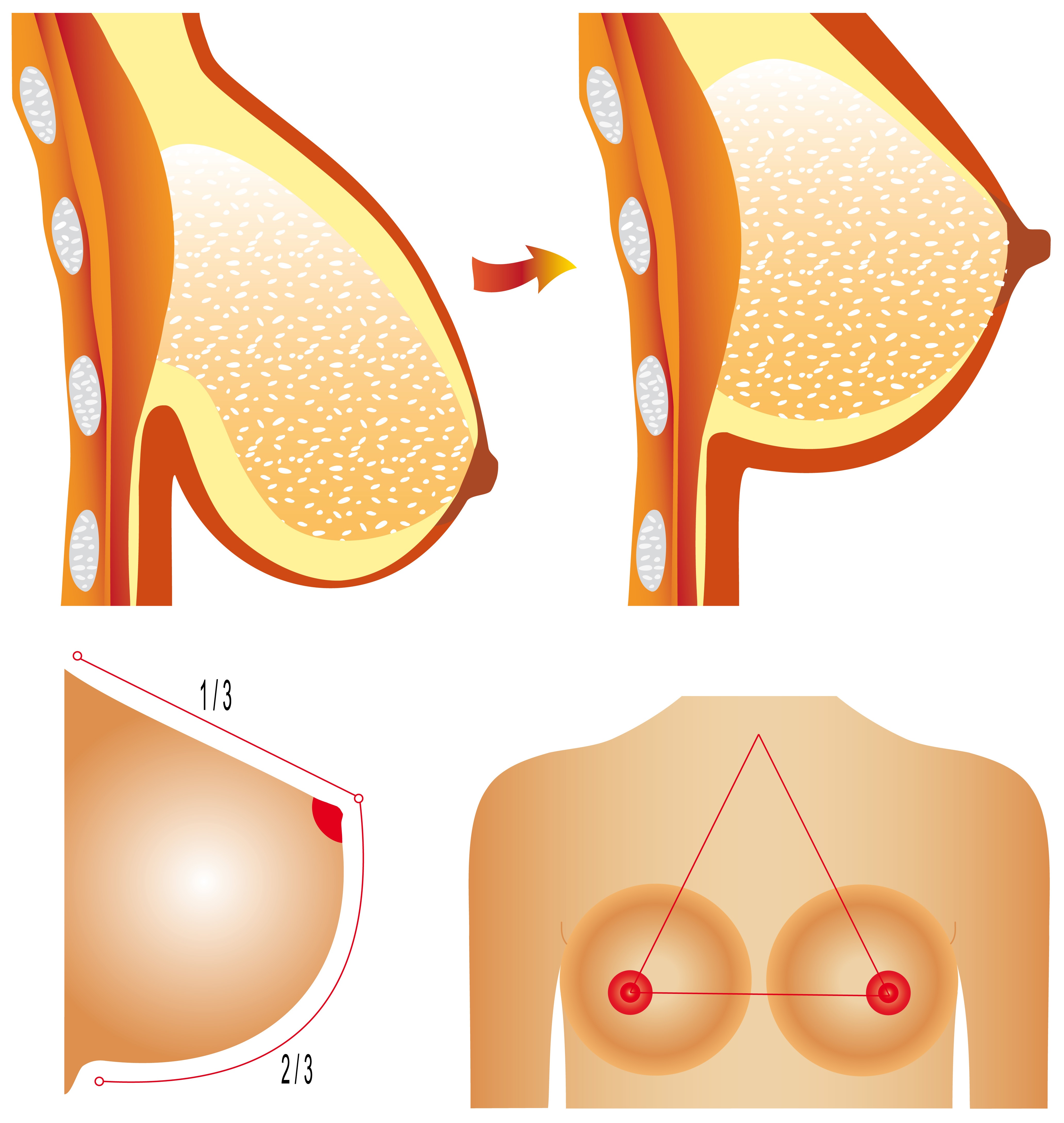 Maintain The Results Of Your Breast Mastopexy