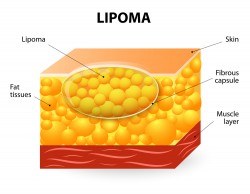 Lipoma Treatment
