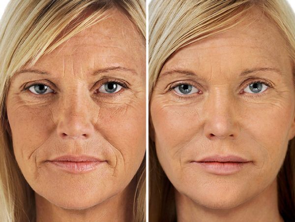 Restylane Smoother 2 Comparison