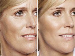 Restylane Smoother comparison