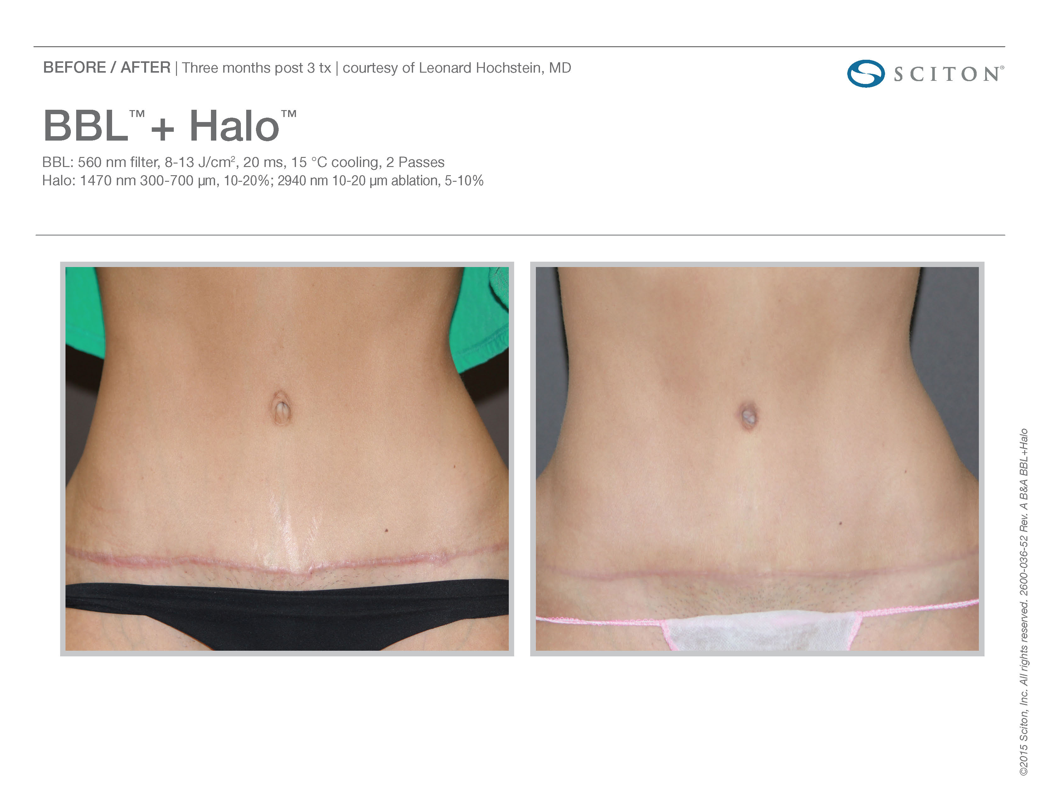 bbl and tummy tuck recovery bbl and tummy tuck recovery