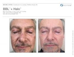 BBL + Halo before & after