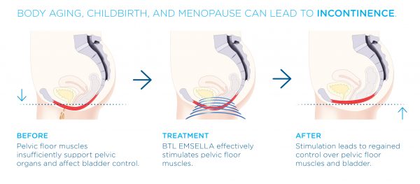 before and after Emsella treatment