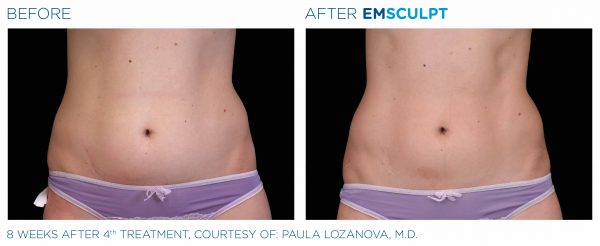 Emsculpt female abs BA