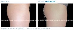 Emsculpt before and after buttocks