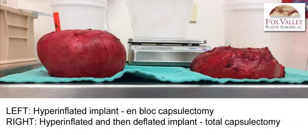 Capsulectomy