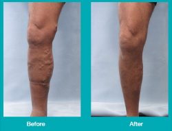 Before and After Leg Images