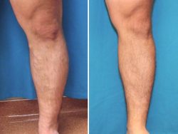 Before and After photos of legs