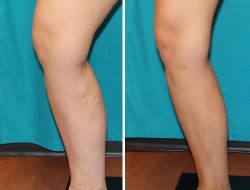 Before and After Photos of Leg