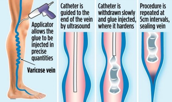 VenaSeal adhesive