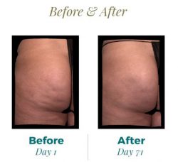 Before and After Qwo injections