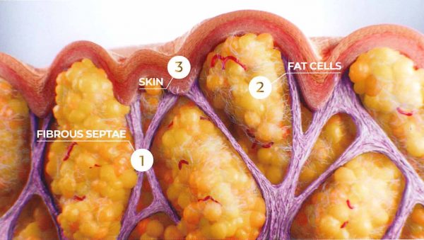 Fibrous septae