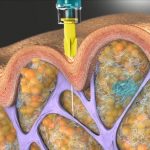 Injection site