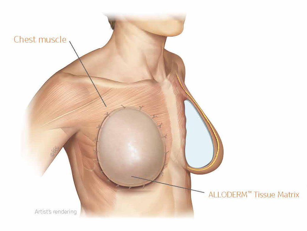 Alloderm Breast Reconstruction