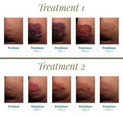 Treatment bruising