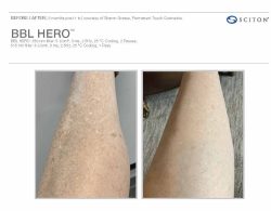 BBL before and after leg