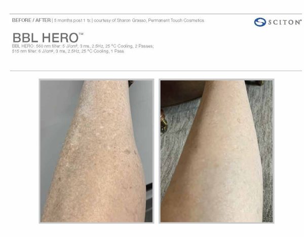 BBL before and after leg