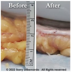 Fat reduction image