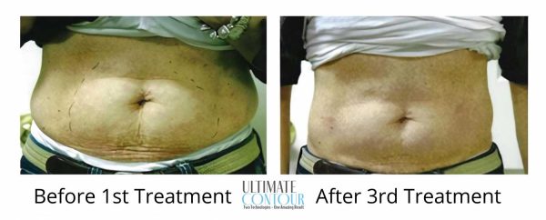 Lose Inches with Ultimate Contour in Wisconsin