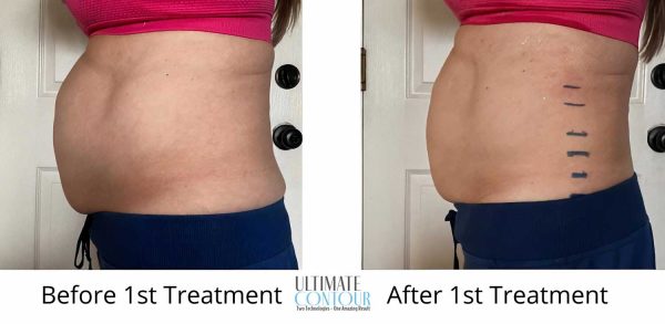 Lose Inches with Ultimate Contour in Wisconsin