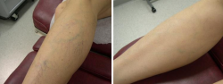 before and after sclerotherapy
