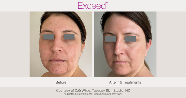 Microneedling before and after