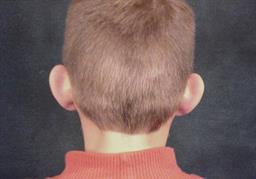 Back of ears before otoplasty