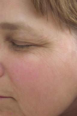 Left side of face before treatment