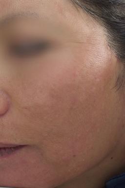 Left side of face after treatment