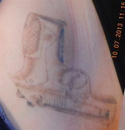 Front view after laser tattoo removal