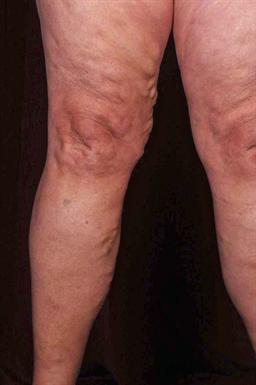 Front of legs before treatment