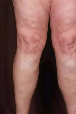 Front of legs after treatment