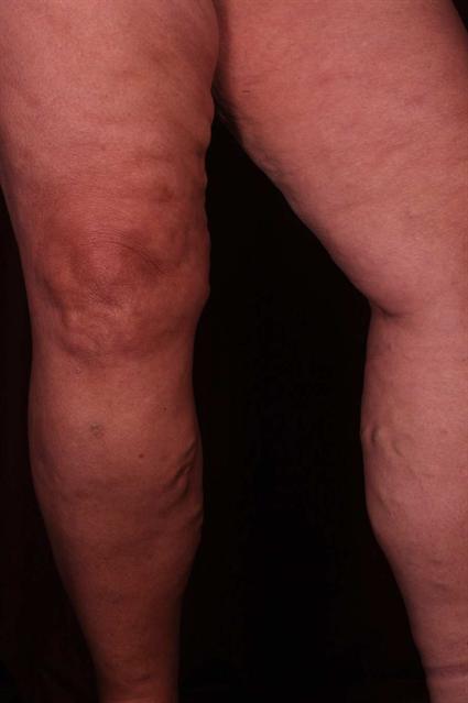 Left Leg Before