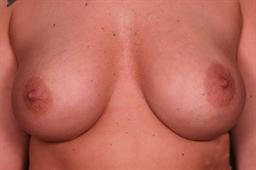 Front of breasts after surgery