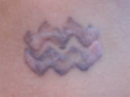 Front view after laser tattoo removal