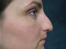 Right view of nose before rhinoplasty