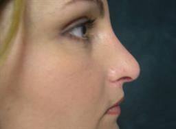 Right view of nose 6 months after rhinoplasty