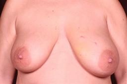 Front of breasts before surgery