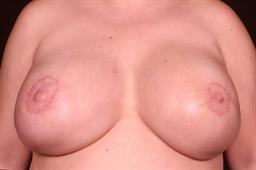 Front of breasts after surgery